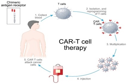 Indigenous CAR-T cell therapy gets rolling: ‘first’ patient is cancer ...